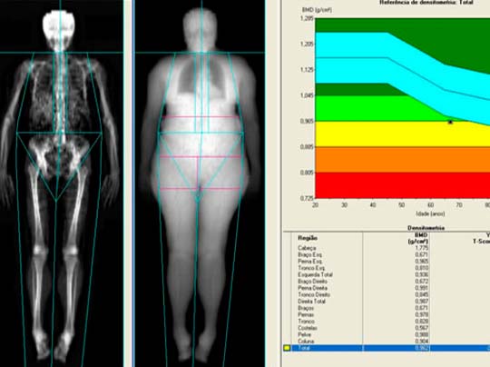 Densitometria Ssea Matsumoto